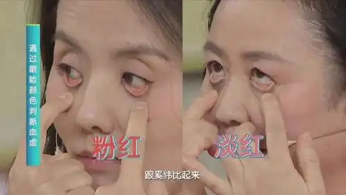 看眼睑,自测是否有血虚症状~ 望面色 观察眼睑内侧,如果发现眼睑颜色