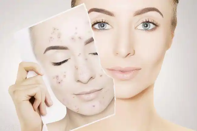 脸上的污垢怎么去除 给面部做好深层清洁才能有好肌肤