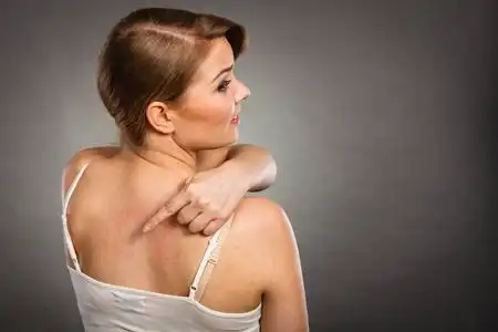 女人为她抓痒背与过敏皮疹照片
