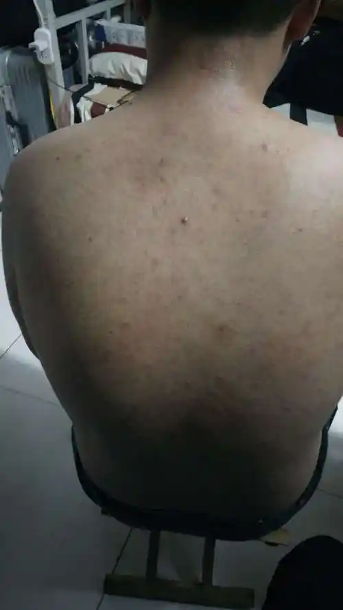 背上长了很多痘痘药店医生说是毛囊炎很痒买了药摸了一段时