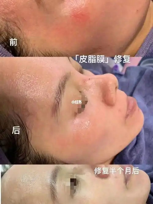 禾壹净甘油套皮脂膜修复18天效果