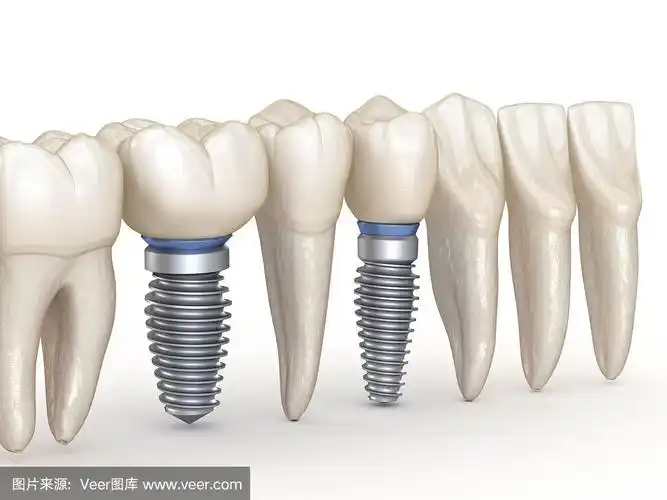 种植牙整齐.人类牙齿的3d插图概念.