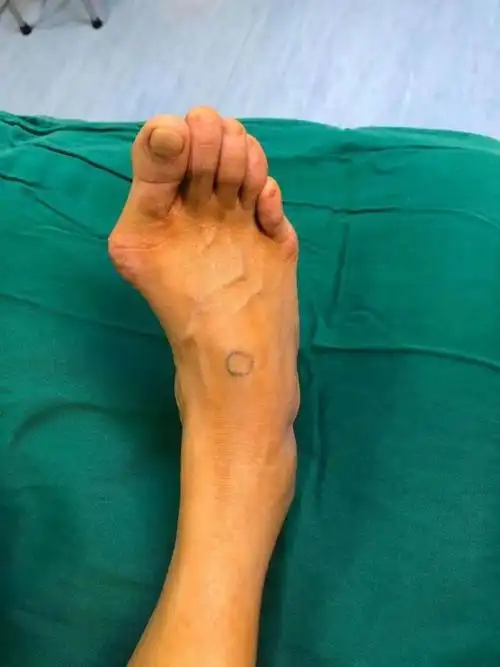 走路疼痛,不敢穿凉鞋?这里有治疗大脚骨的好方法