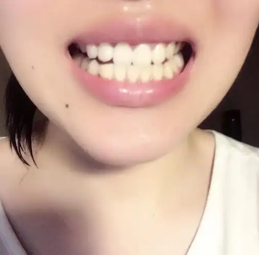 请问 这样的牙齿需不需要矫正?谢谢