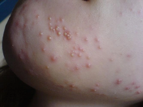 如何护理新生儿脓疱疮新生儿脓疱疮的治疗及护理