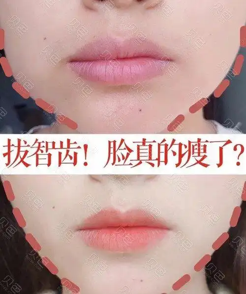 为啥十个牙医九个都建议拔掉,能改变脸型是不是骗局