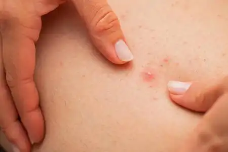 女性挤腿毛囊炎照片