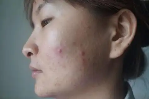 针对混合性皮肤的牌子 本人28岁,皮肤为混合偏油性皮肤,用什么牌子