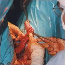 toby meltzer performs srs(早期的变性手术,到现在已经很成熟了)