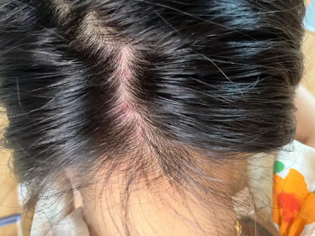 女子每月染发1次,10年后竟得肝硬化?医生:染发时,5点铭记于心