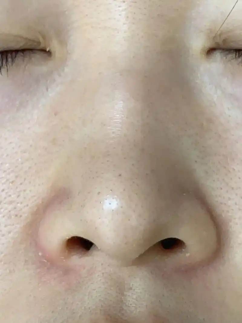 重度黑头终于没了……本人油皮,毛孔粗大,又喜欢 - 抖音