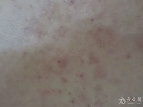 男士背部的瘙痒—— 脂溢性皮炎