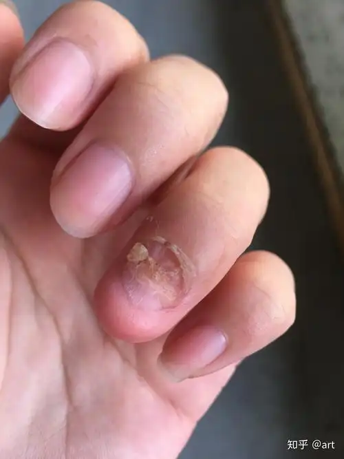 一个人喜欢不自觉的啃手指甲反映了什么潜在的生理心理特征