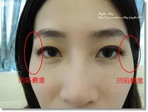 一,夫妻宫凹陷的女性