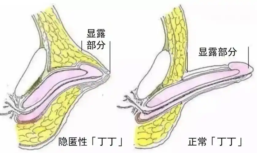 隐匿性阴茎多合并包茎,但手术方式大相径庭,缺乏经验的医生可能会误