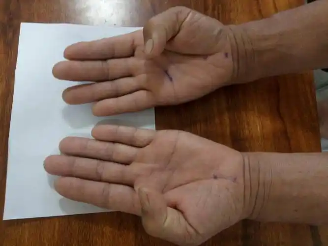 术前拇指对掌功能差