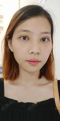 全切双眼皮术后7天_开眼角术后7天_双眼皮术后7天_眼部整形术后7天