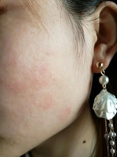 脸上起红斑有时候有些痒涂水乳面膜还会刺痛是怎么回事