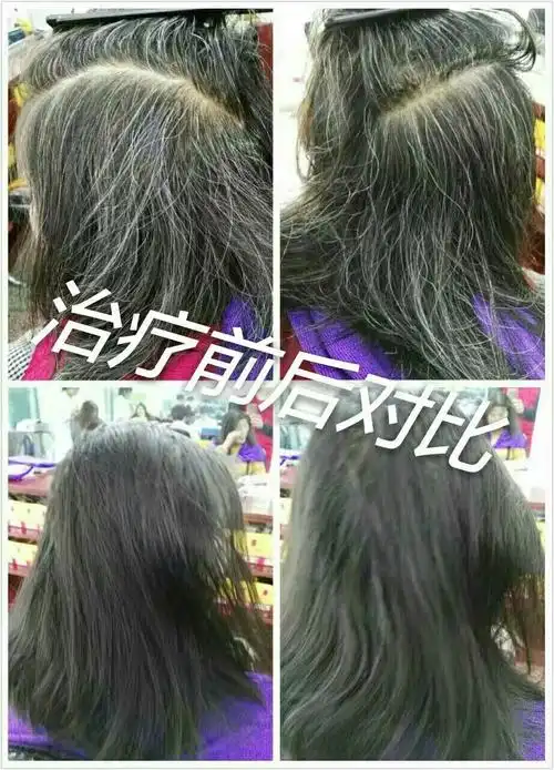 中药治疗,白发转黑,20天见效