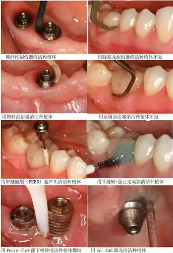 医生我的种植牙生病了怎么办还留的住吗种植体周围炎详解