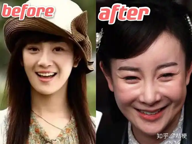 王子文填充后越来越少女了最会填充的女明星