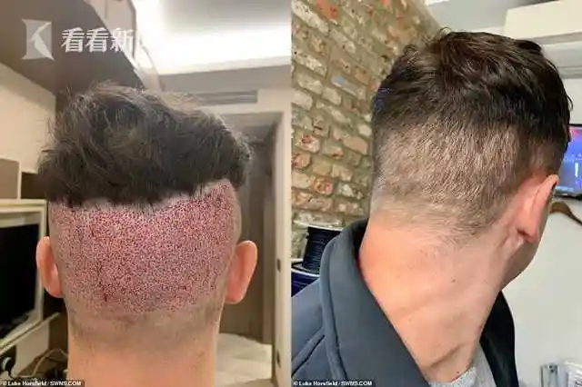 吓人it男贪图诱人超低价出国植发头皮竟布满虫卵险致崩溃
