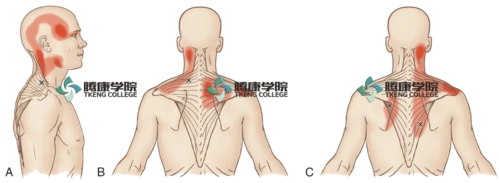 斜方肌扳机点的按摩手法