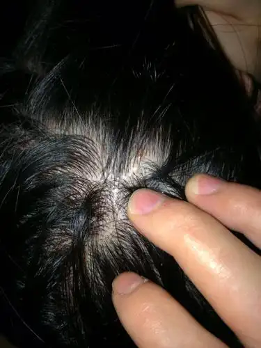 头皮红了还有些疙瘩,是怎么回事?