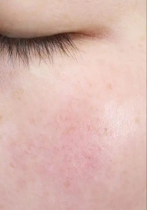 【扩散】拿什么来拯救你——红血丝|光子嫩肤|角质层|保湿|美容_网易