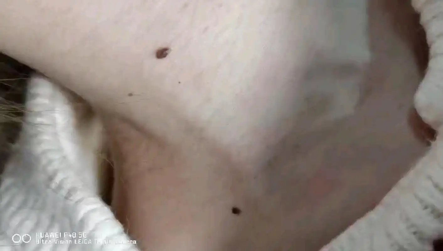 脖子右侧的痣 若是一个人的脖子左侧位置长有恶痣,别称之为破财痣