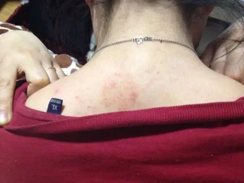 2回答 失枕了脖子疼怎么才能好～谢谢 2回答 30 今天早上起来腋窝疼