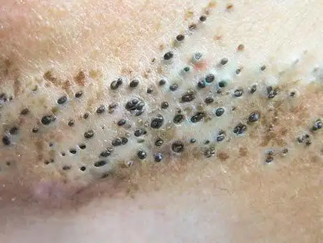 第一,黑头粉刺,也叫开放性粉刺,用肉眼可看到扩大的毛孔,并有黑头创