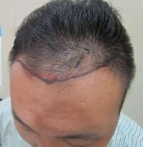 脱发 疤痕修复 毛囊移植案例
