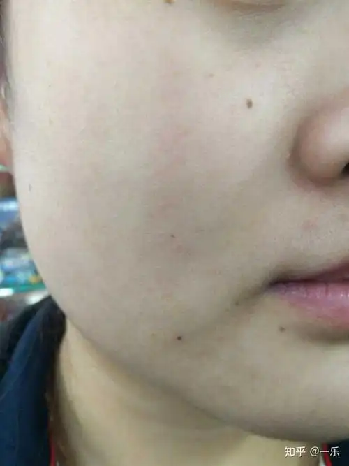 角质层薄的人该怎么护肤?