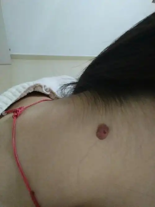 求各位宝妈支招怀孕后,脖子后面的痣竟越来越大了,该怎么