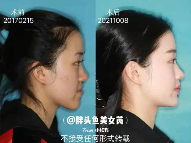 07正颌手术前后对比历时4年