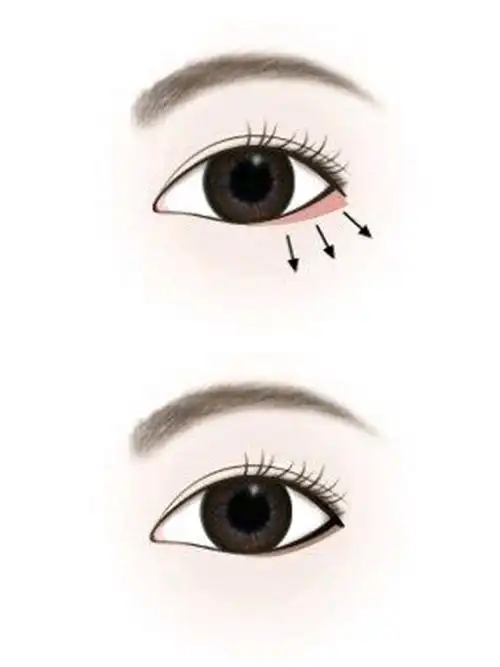 下睑下至手术就是人为地让下眼睑向下退                    ,通常