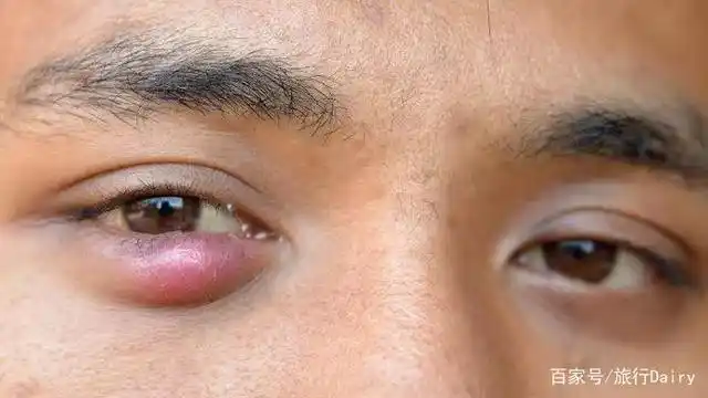 急性泪囊炎,化脓性睑板腺囊肿,急性泪腺炎,骨膜炎,眼睑皮肤结核,梅毒