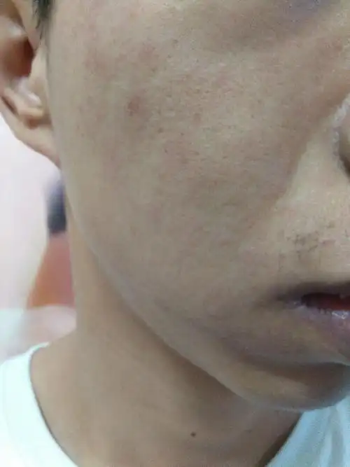 最近空气干燥,昨天脸部觉得辣辣的