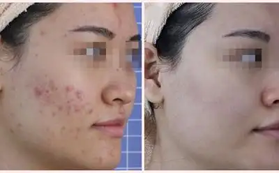 痘痘怎么消除小妙招