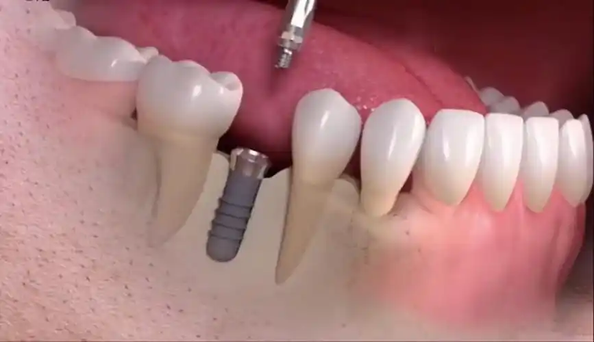 不,有,可以做种植牙,种植牙堪称人类第三幅牙齿,在功能和美观度