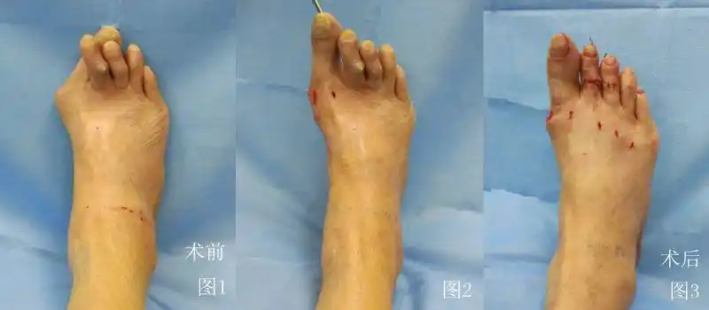 我院成功实施国内首例微创关节镜拇外翻合并跖痛手术