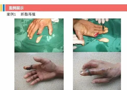 长期开展断指(趾),断肢再植,手足四肢外伤的血管神经肌腱骨折等急