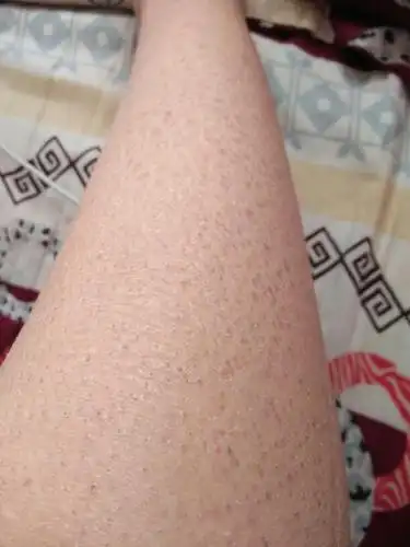 现在长大了自己看着都觉得恶心,大腿上的以前看过医生说什么毛孔堵塞