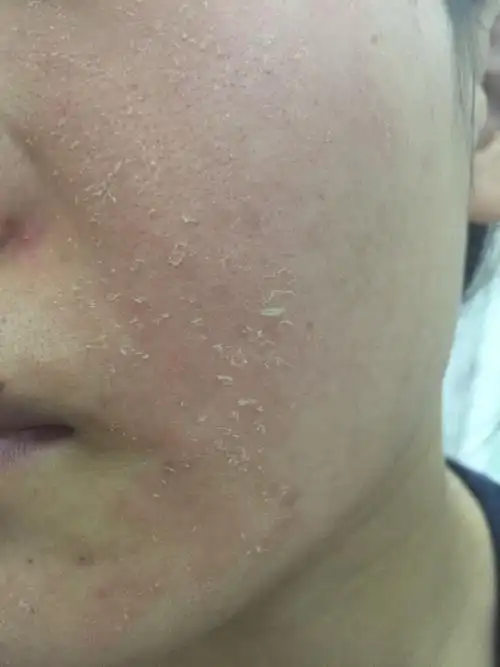 一开始脸非常痒,很红,抹上霜会很痛,几天后脸开始脱皮.