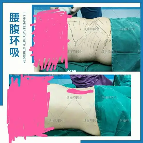 腰腹环吸案例分享_腰腹_美容_减肥_减肥医药