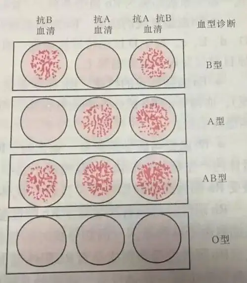 我们医学部的学生在生理学实验课上都会做这个鉴别血型的凝集实验,就