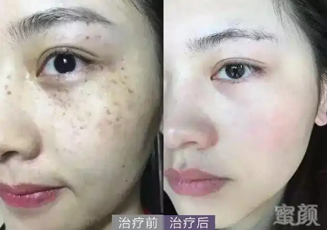 治疗前,后效果对比