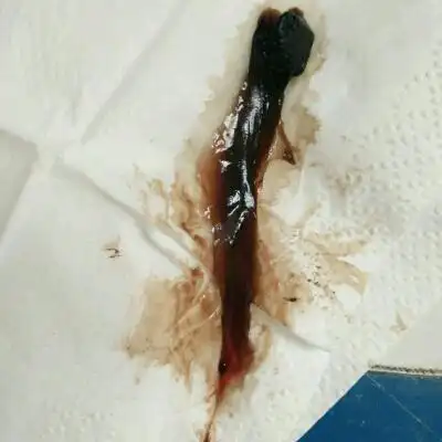 今天这是出的第一次黑色血块,后面也出了点血块,但是没有这麼多,后面