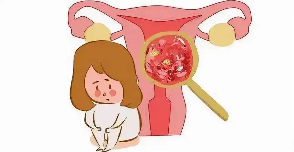 30~50岁的育龄期女性子宫肌瘤是女性发病率非常高的一种良性肿瘤煤